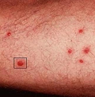 Cómo tratar el prurito