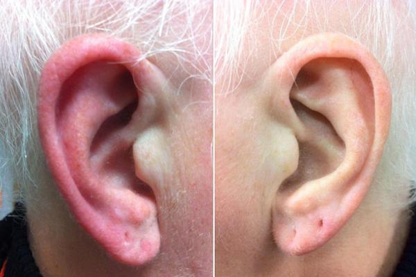 Por qué se me calientan las orejas - Síndrome de la oreja roja 