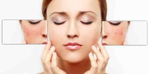 Cómo quitar las marcas de la cara