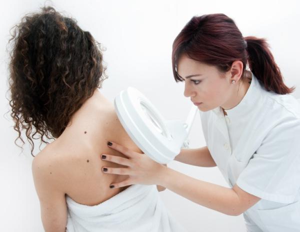 Cómo saber si un lunar es benigno