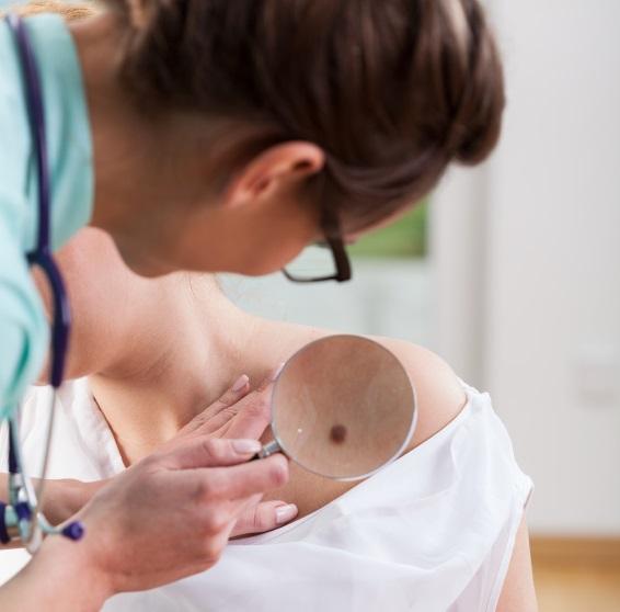 Cómo saber si un lunar es benigno - Paso 1