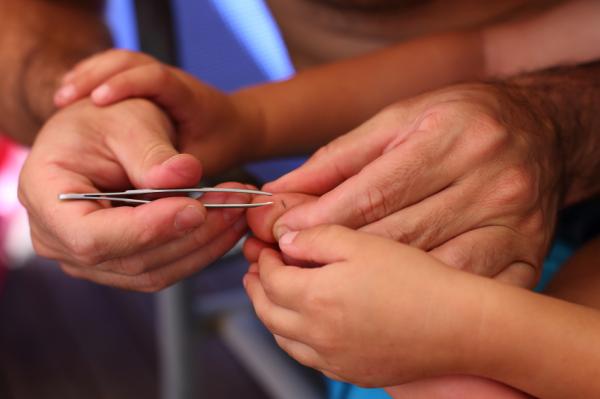 Cómo quitar una astilla sin dolor