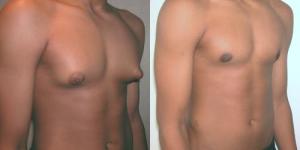 Cómo eliminar la ginecomastia en adolescentes