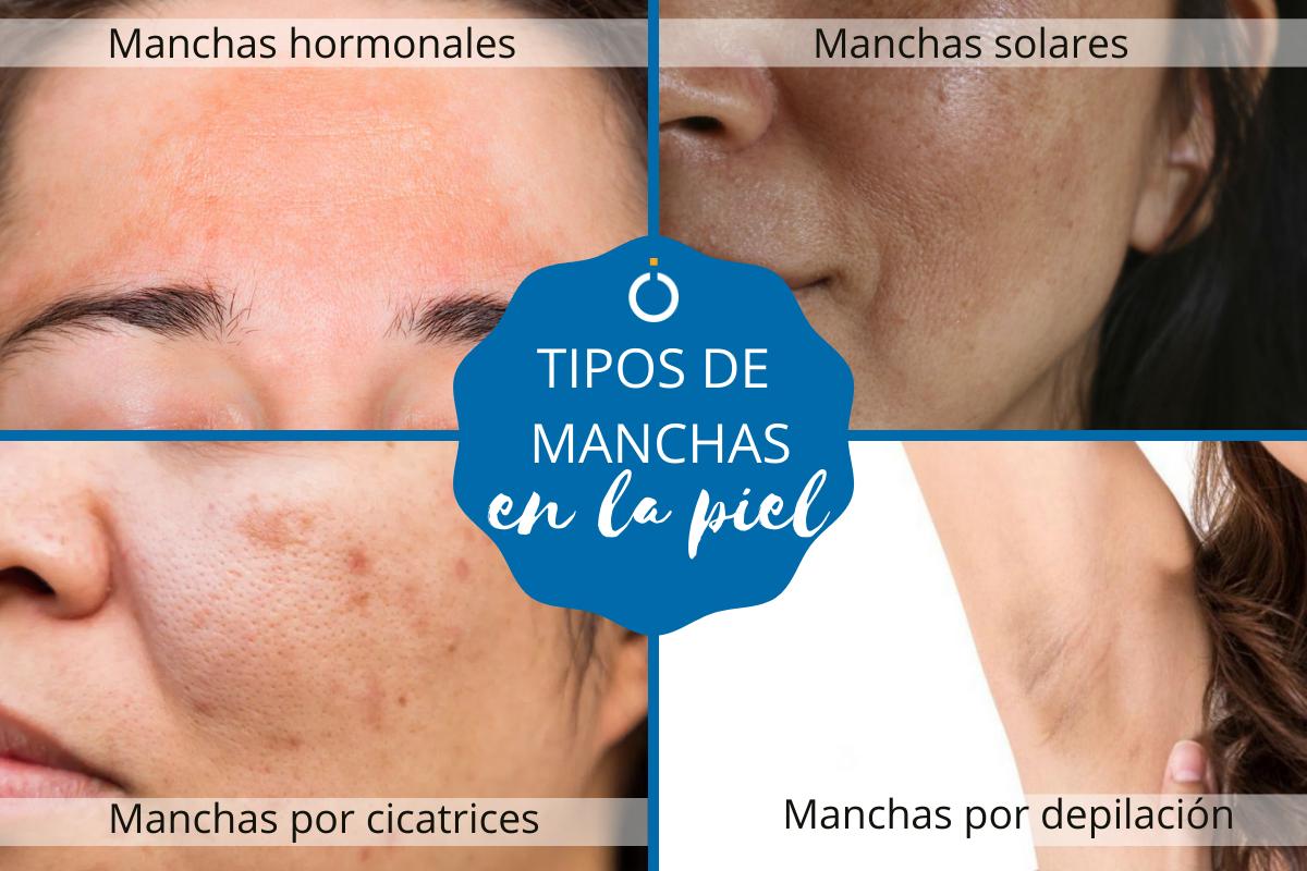 Tipos de manchas en la piel y cómo tratarlas