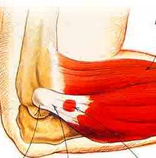 Cómo tratar la Epicondilitis