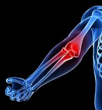 Cómo tratar la Epicondilitis - Paso 4