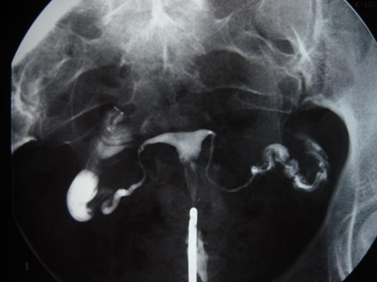 Qué es la histerosalpingografía