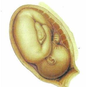 Cómo son las contracciones en el desprendimiento prematuro de la placenta