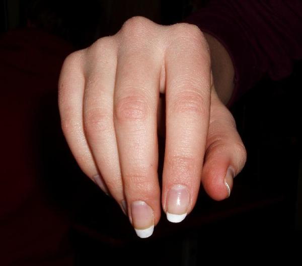 Cómo diagnosticar los trastornos de uñas