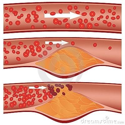 Cuáles son las causas de los triglicéridos altos