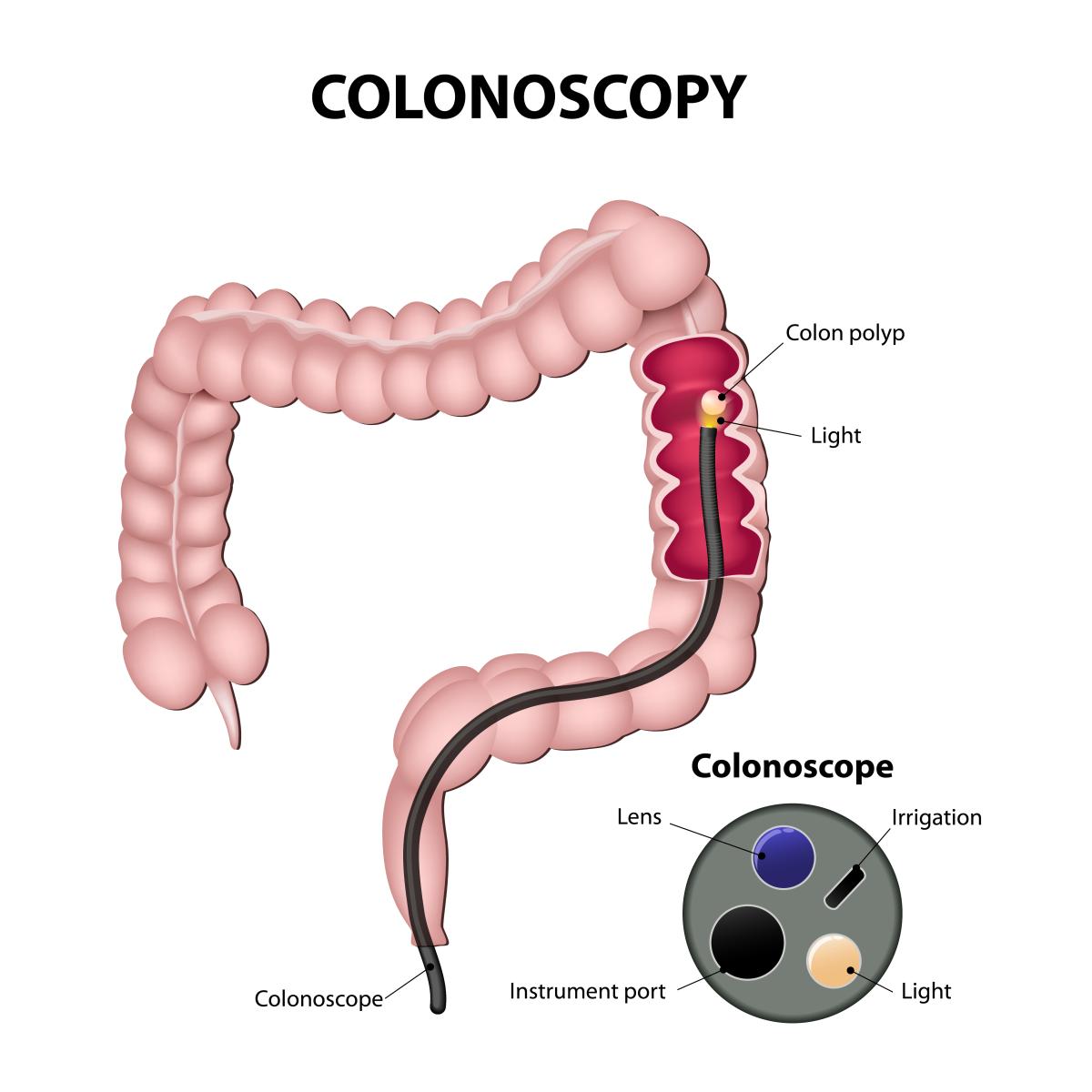 Cómo tratar los pólipos en el colon
