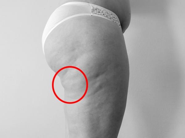 Cómo quitar la grasa de debajo de los glúteos