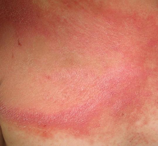 Cómo se manifiesta la psoriasis