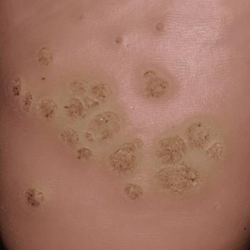 Cómo detener el contagio de las verrugas genitales