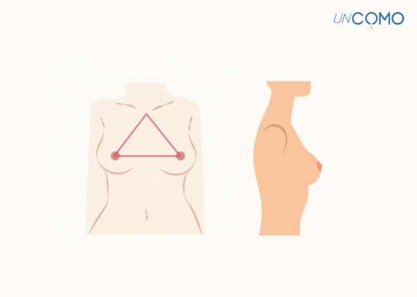 Tipos de senos - Pechos redondos