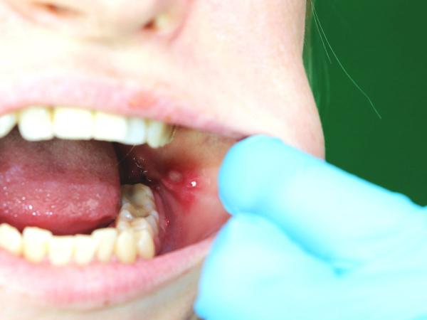 Por qué salen llagas en la boca y cómo curarlas - Cómo curar llagas en la boca