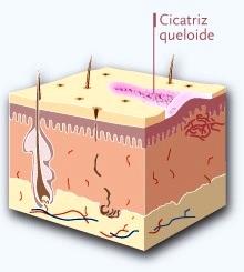 Cómo detener la formación de queloides