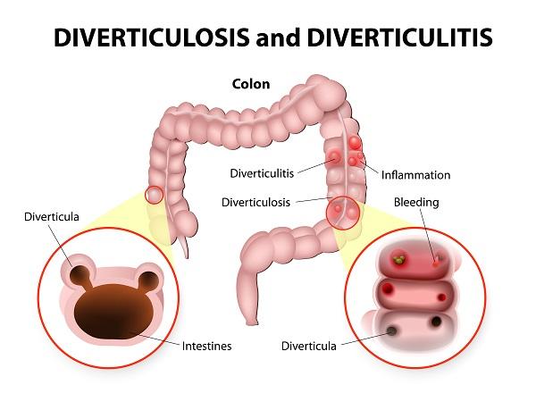 Cómo se manifiesta la diverticulosis - Paso 1