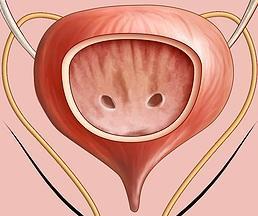 Cómo tratar la estrechez de la uretra
