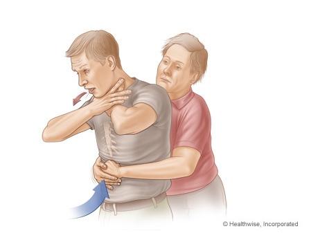 Cómo actuar ante un atragantamiento