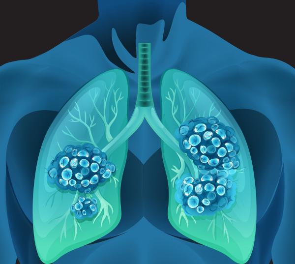 Causas de las manchas en los pulmones - Cáncer de pulmón 
