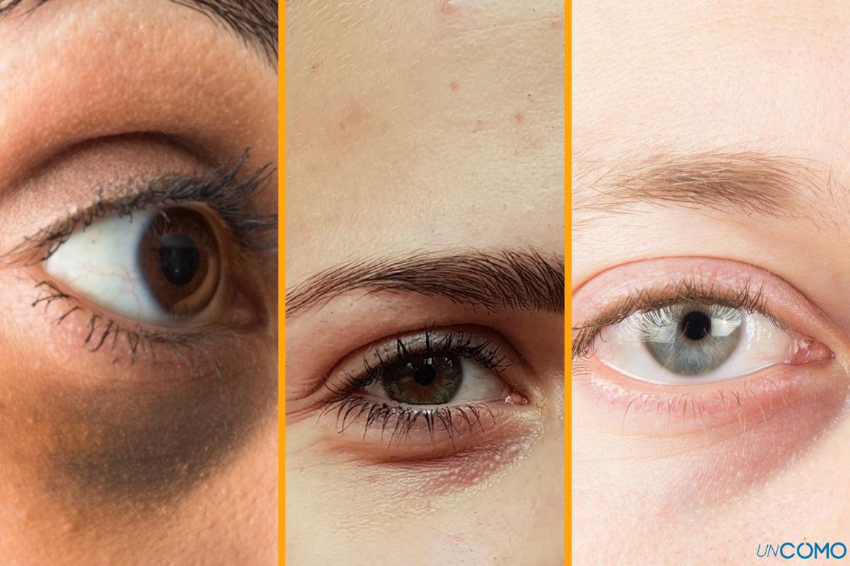 Tipos de ojeras y cómo tratarlas