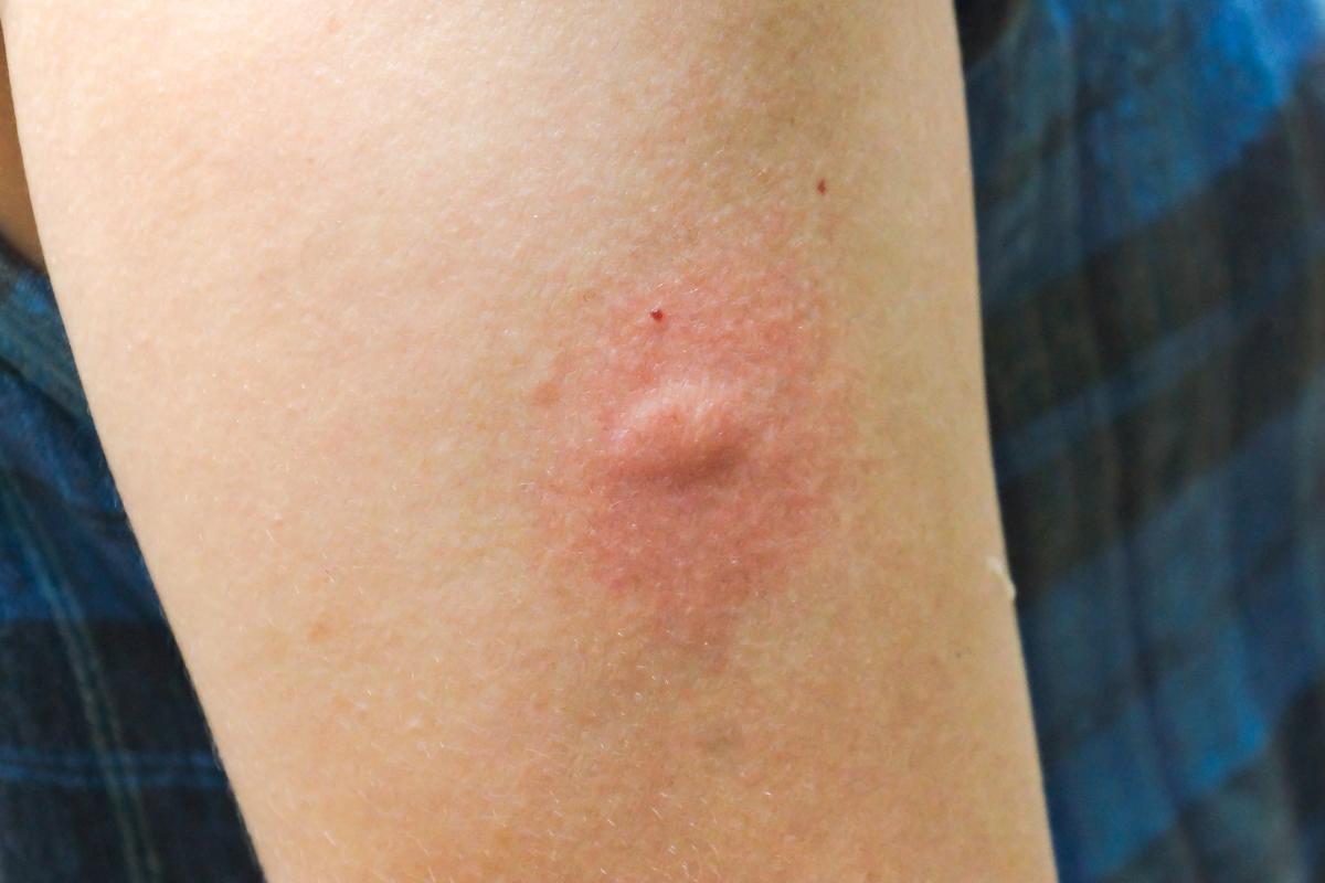 Cómo bajar la inflamación de una picadura de mosquito