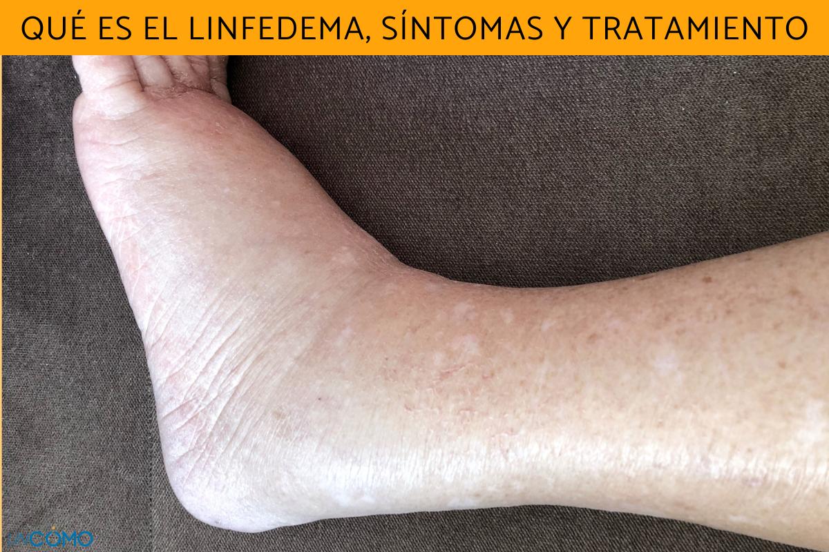Qué es el linfedema, síntomas y tratamiento
