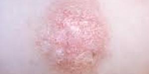 Cómo tratar la pitiriasis rosada