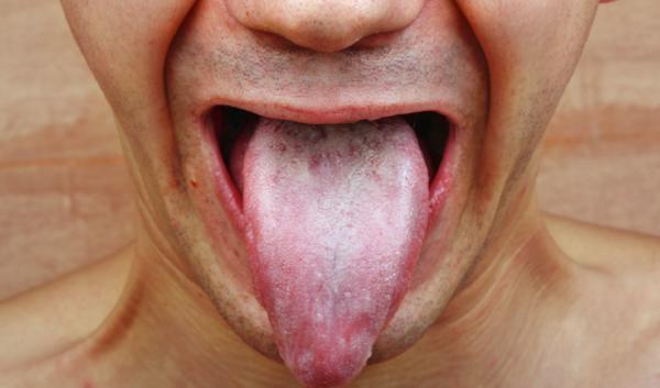 Por qué tengo las encías blancas - Candidiasis oral