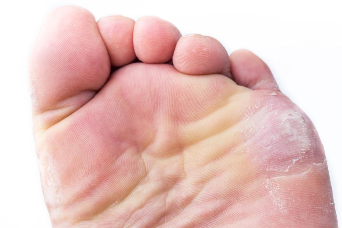 Remedios caseros para los hongos en la planta del pie