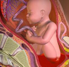 Cómo es el tratamiento de la placenta previa