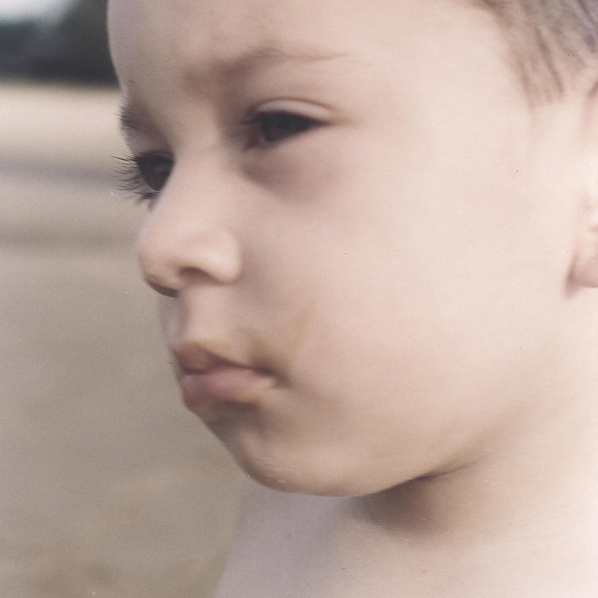 Cómo tratar la piel muy seca en los niños