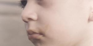 Cómo tratar la piel muy seca en los niños