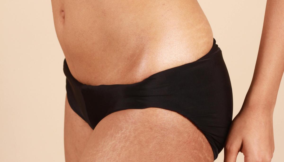 Cómo aclarar la zona íntima