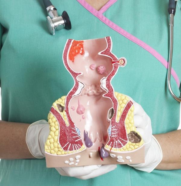 Por qué tengo un bulto en el ano - conoce las causas - Bulto anal por cáncer en el ano