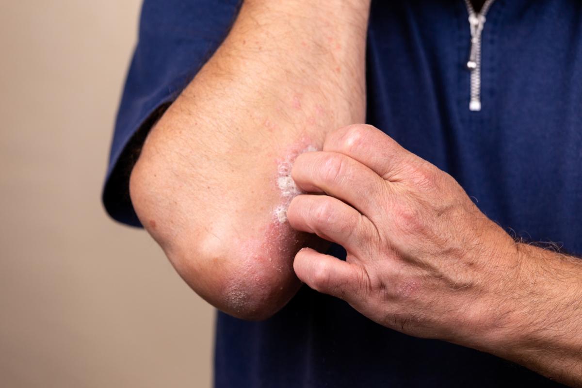 Remedios caseros para la dermatitis atópica