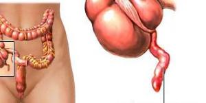 Cómo tratar la peritonitis