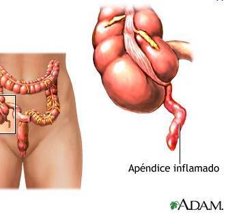 Cómo tratar la peritonitis
