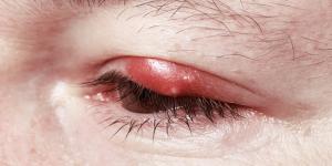 Cómo bajar la hinchazón de un orzuelo