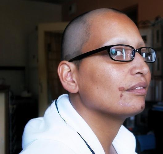 Cómo tratar el cáncer de piel