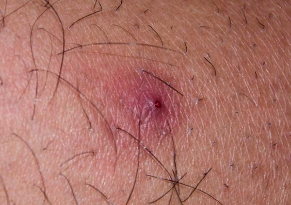 Por qué salen costras en la cabeza - Foliculitis en el cuero cabelludo